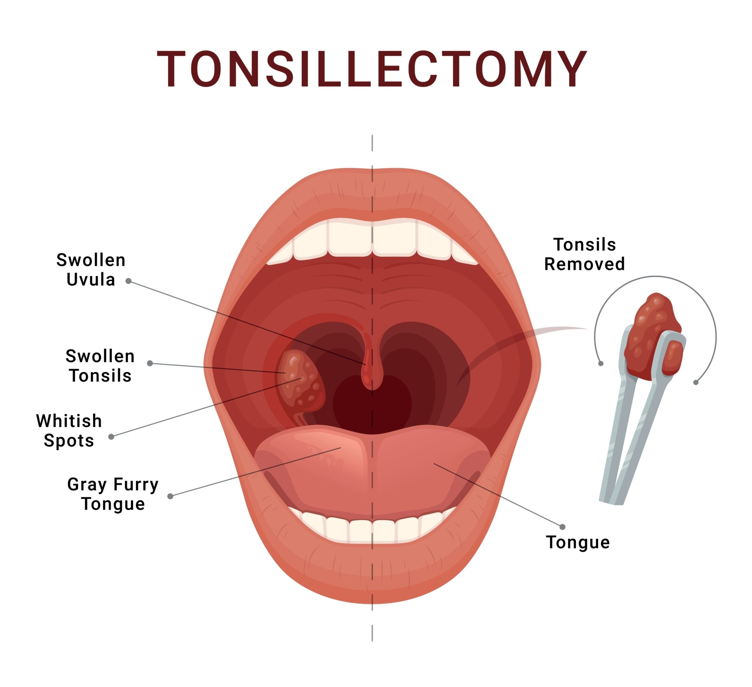 tonsillectomy