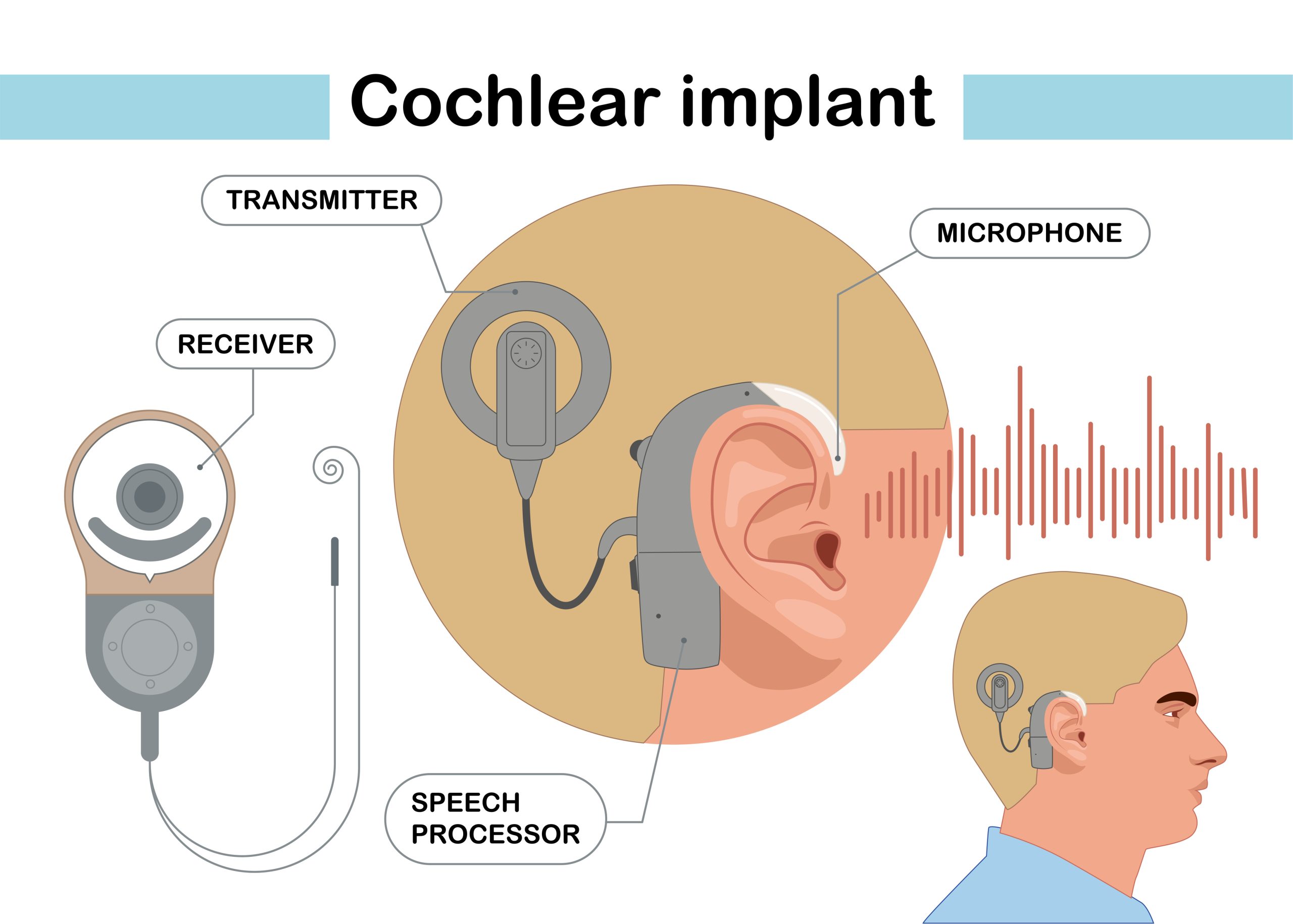 Cochlear-implant-device-illustration-in-flat-style-scaled