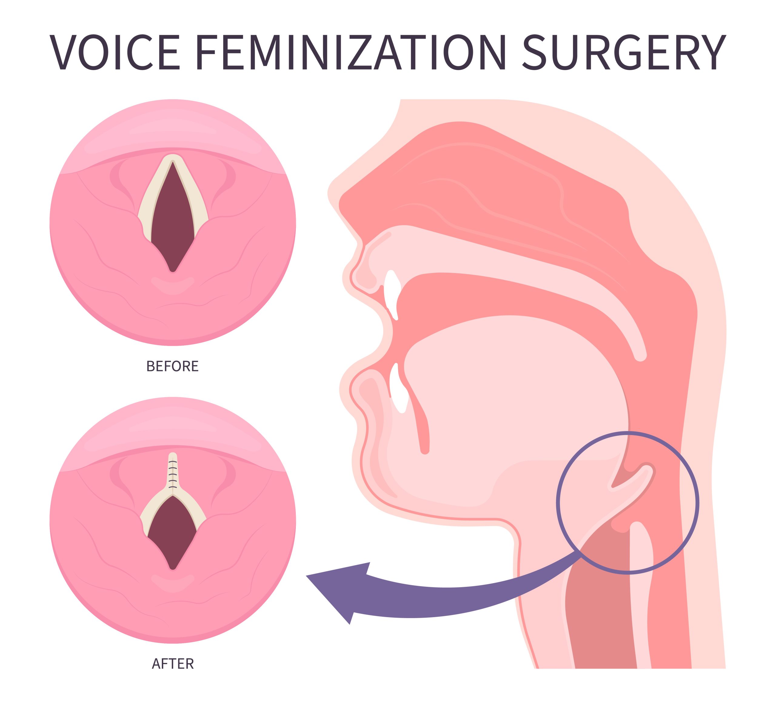 Voice-Feminization-Surgery