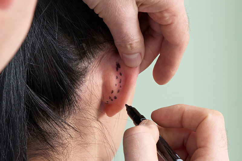 woman otoplasty