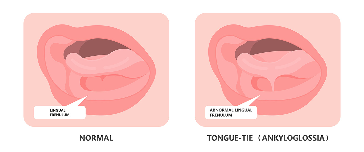 tongue-tie