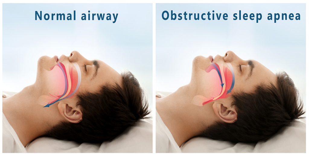 what-is-sleep-apnoea